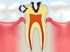 C2：象牙質の虫歯（う蝕症第2度）
