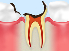 C3：神経まで達した虫歯（う蝕症第3度）