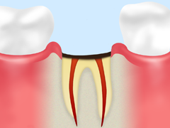C4：歯冠崩壊状態（う蝕症第4度）